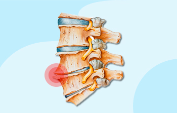 How to Manage Degenerative Disc Disease Through Non-Surgical Ways
