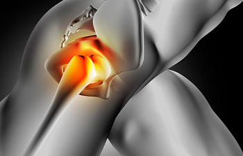 Total Hip Replacement (THR): A Transformative Solution for Advanced Hip Osteoarthritis